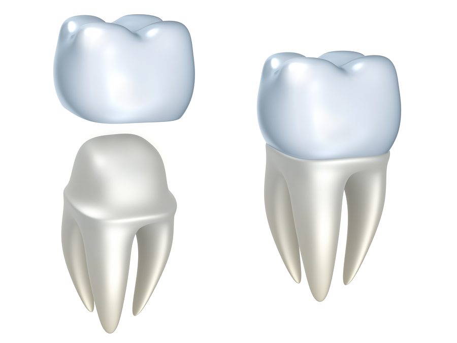 Why CEREC is the Best Way to Restore Your Teeth in a Single Visit