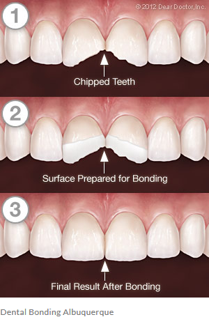 Bonding - New Age Dentistry Dental Bonding Albuquerque | Tooth Bonding ...